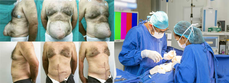 Cirugía Pared Abdominal - Hernia